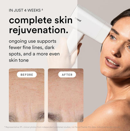 Nood™ Flasher Pro – IPL Laser Hair Removal Device – At-Home Hair Reduction