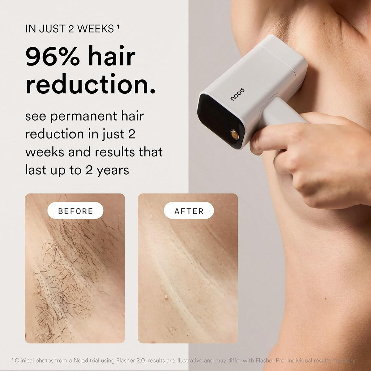 Nood™ Flasher Pro – IPL Laser Hair Removal Device – At-Home Hair Reduction